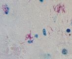 TB bacteria in the lung. The bacteria have been stained red so they can be seen. 